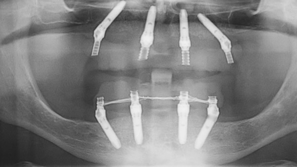 all on four controindicazioni